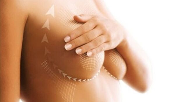 lifting des sutures pour augmentation mammaire