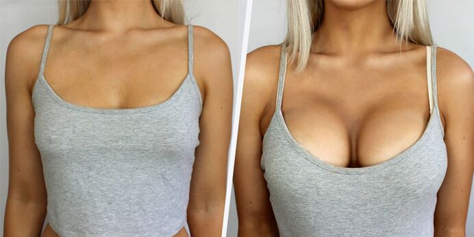 avant et après chirurgie plastique pour augmentation mammaire