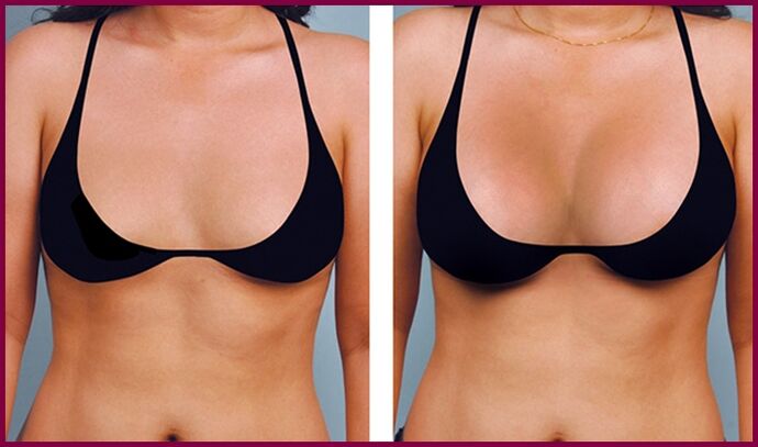 avant et après augmentation mammaire avec graisse