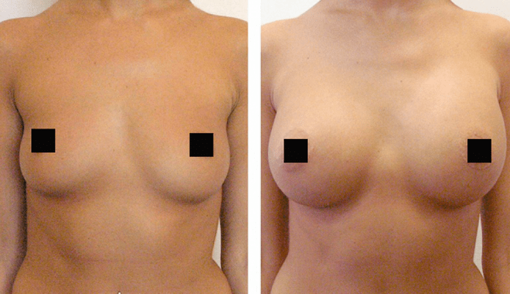 seins avant et après augmentation avec de l'acide hyaluronique
