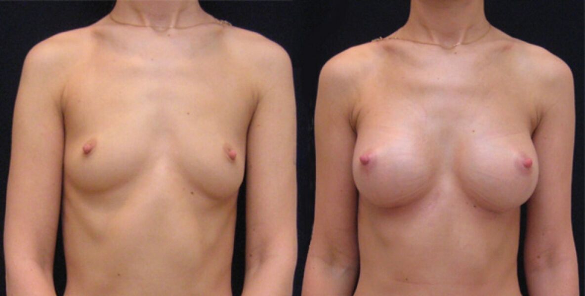 sein avant et après augmentation endoscopique