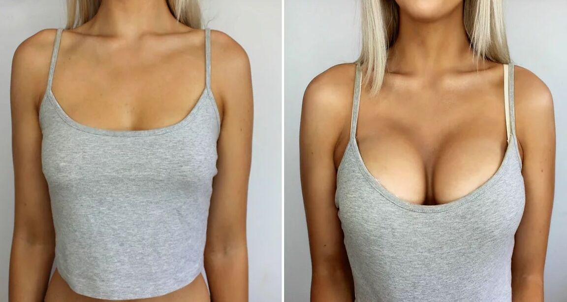 Élargissement du sein 3 taille