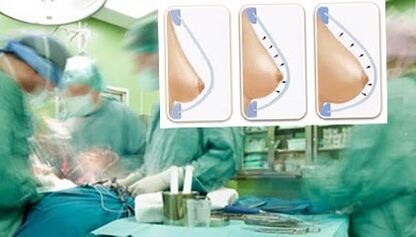 Comment le lipilifting mammaire est effectué