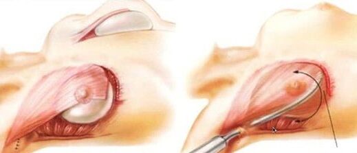 Comment le fonctionnement de l'augmentation mammaire est effectué