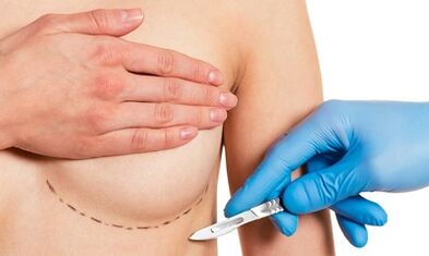 Accès sous-dynamique à l'élargissement du sein avec les implants