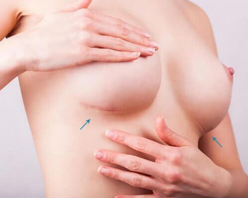 Élargissement du sein avec les implants