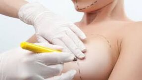 chirurgie d'augmentation mammaire