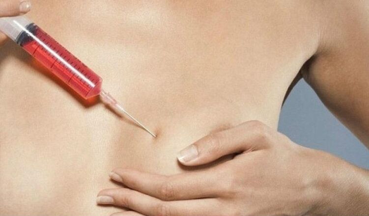 Augmentation mammaire par injections d'acide hyaluronique