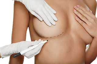 Marquage avec un marqueur avant la chirurgie d'augmentation mammaire